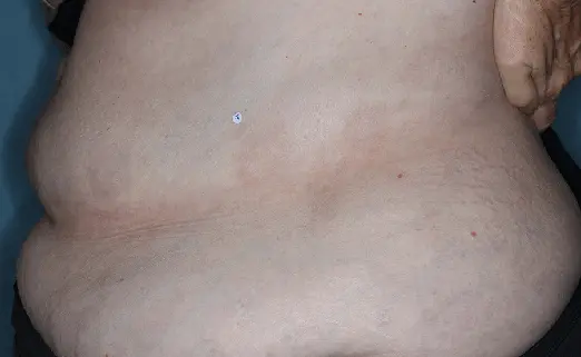 Patient 4 torso baseline vs 8 weeks