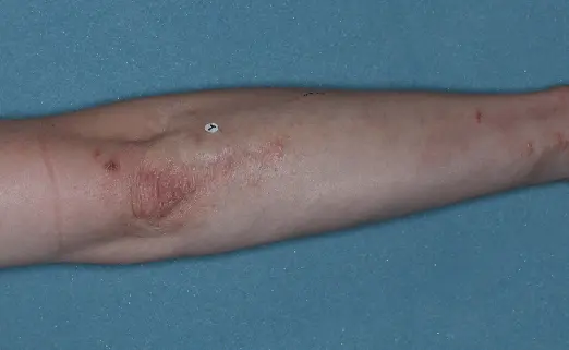 Patient 1 arm baseline vs 8 weeks