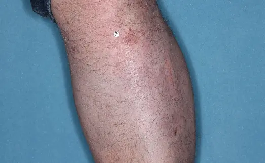 Patient 3 leg baseline vs 8 weeks