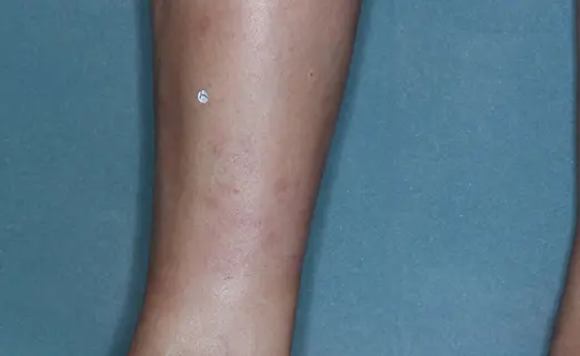 Patient 2 leg baseline vs 8 weeks