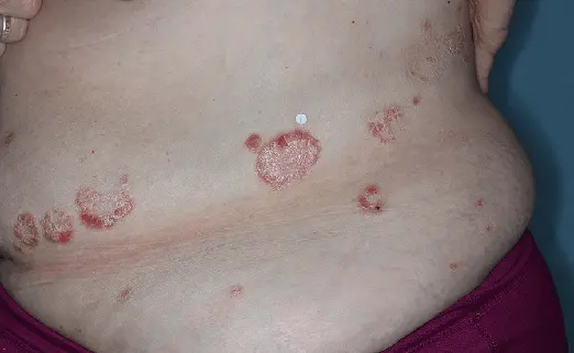 Patient 4 torso baseline vs 8 weeks