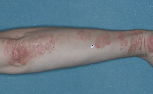 Patient 1 arm baseline vs 8 weeks