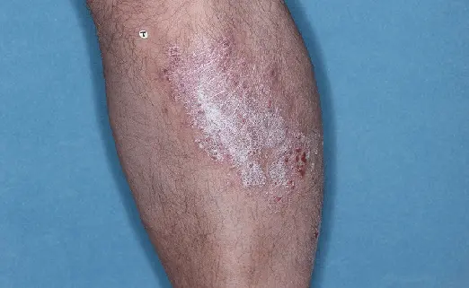 Patient 3 leg baseline vs 8 weeks