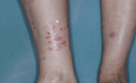 Patient 2 leg baseline vs 8 weeks