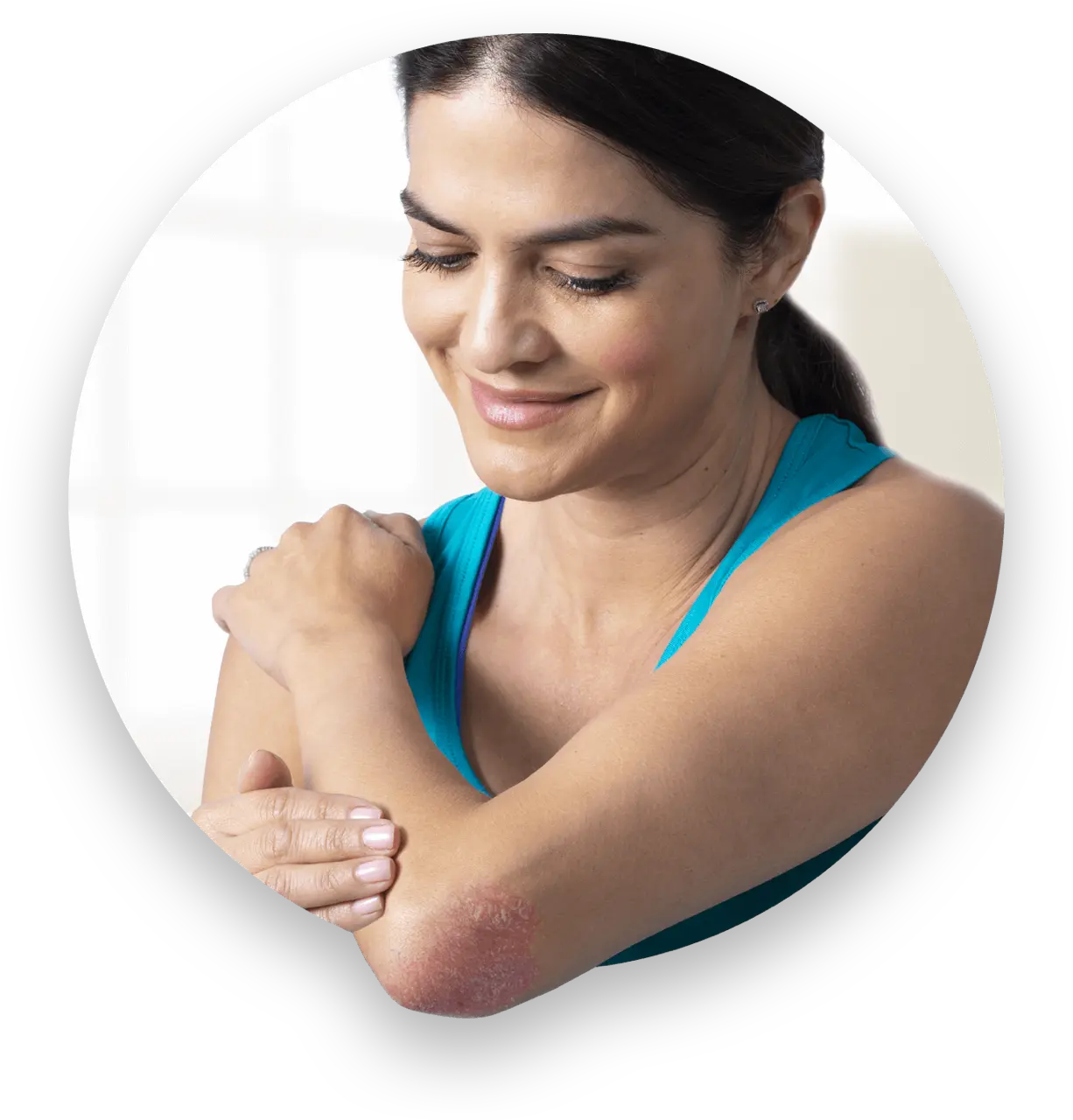 Patient applies DUOBRII Lotion to plaque psoriasis