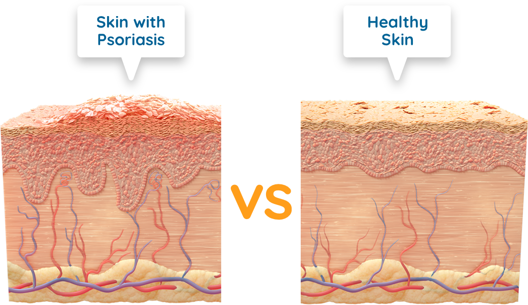 Illustration of skin with plaque psoriasis vs healthy skin