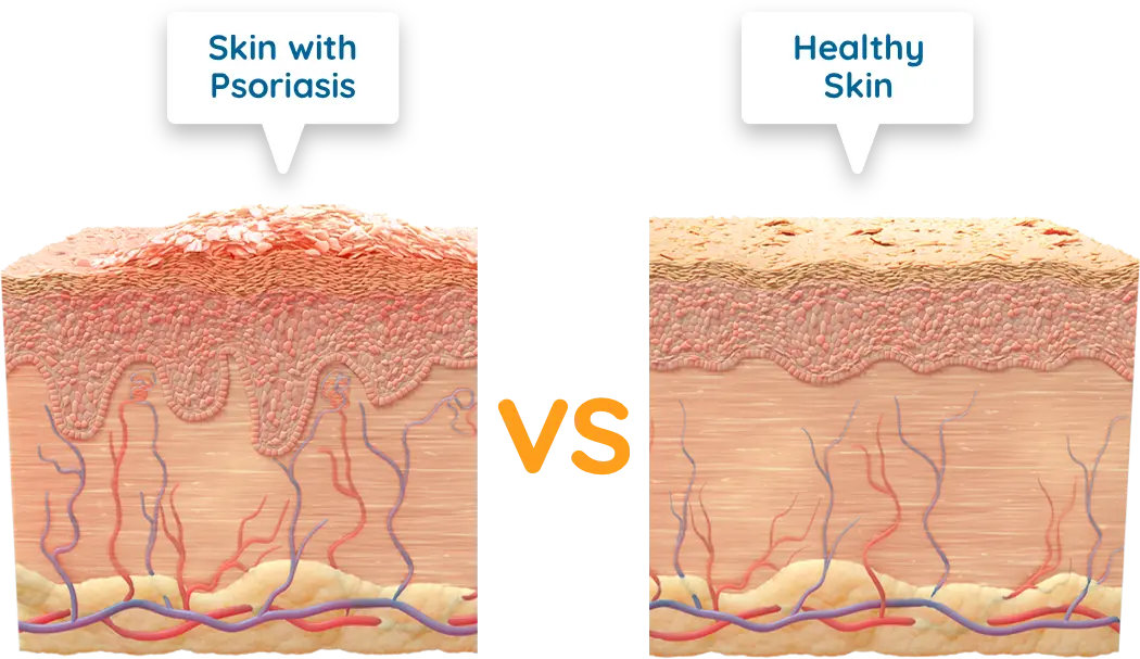 Illustration of skin with plaque psoriasis vs healthy skin