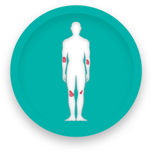 Human figure with moderate plaque psoriasis