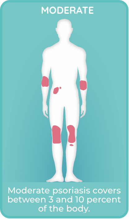 Moderate plaque psoriasis covers 3% - 10% of the body