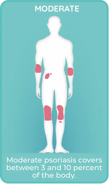 Moderate plaque psoriasis covers 3% - 10% of the body