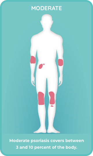 Moderate plaque psoriasis covers 3% - 10% of the body
