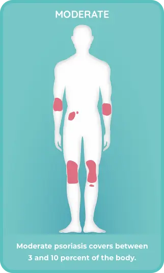 Moderate plaque psoriasis covers 3% - 10% of the body