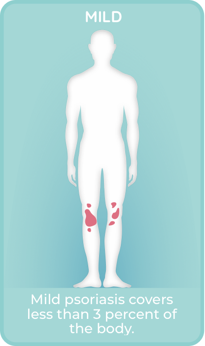 Mild plaque psoriasis covers < 3% of the body