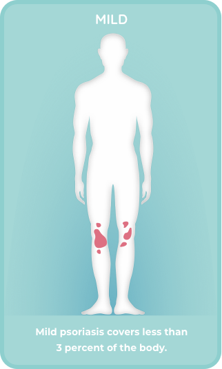 Mild plaque psoriasis covers < 3% of the body