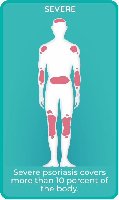 Severe plaque psoriasis covers > 10% of the body