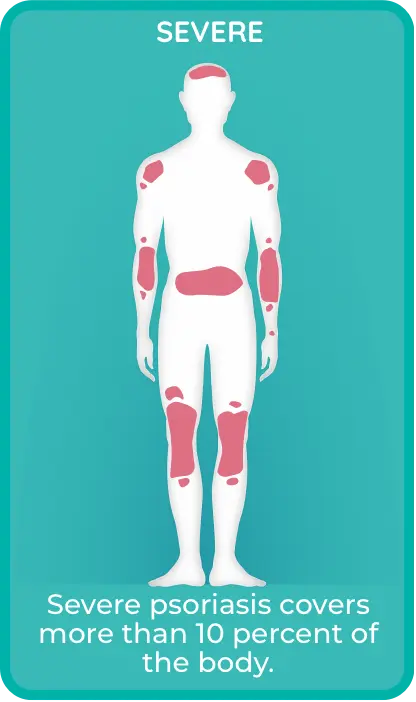 Severe plaque psoriasis covers > 10% of the body