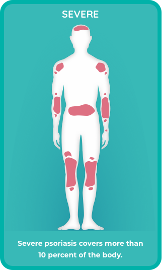 Severe plaque psoriasis covers > 10% of the body